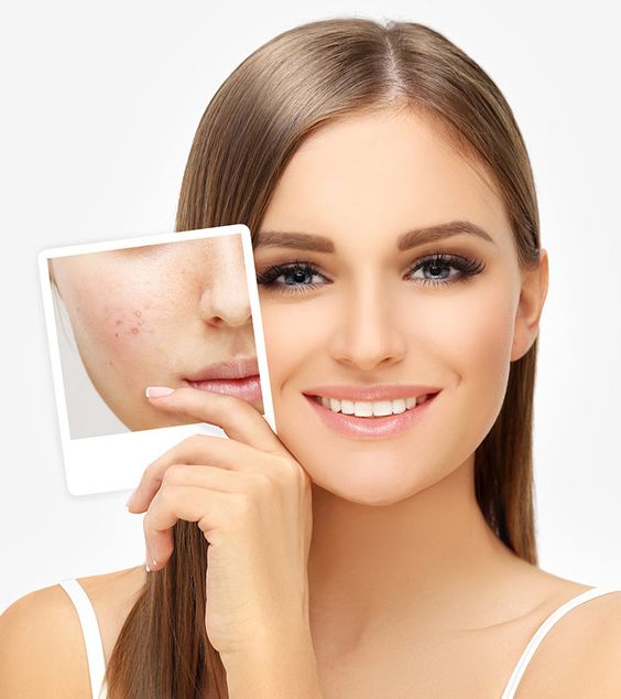 New Innovations In Acne Scar Treatment Technologies