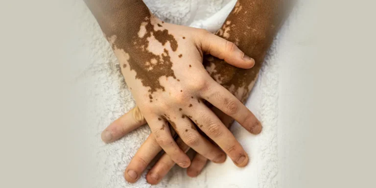 Symptoms and Early Signs of Vitiligo