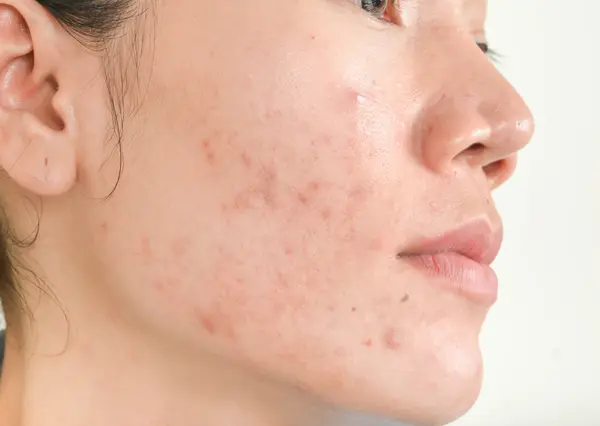 Fading the Marks Understanding and Treating Acne Scars.