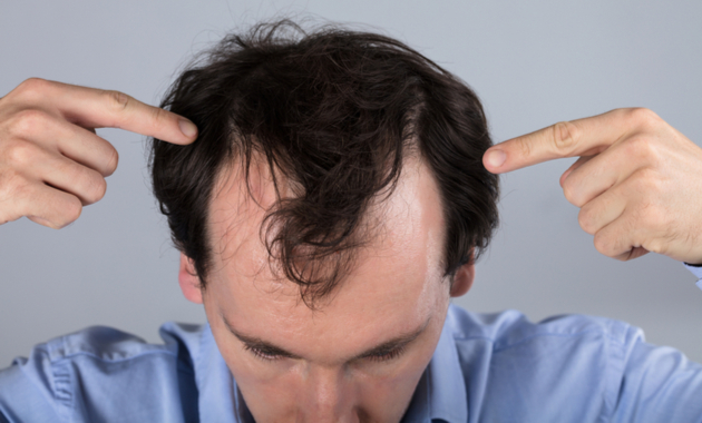 A Comprehensive Guide to Hair Loss Treatment.