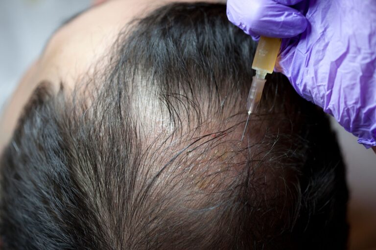 Revitalizing Tresses Exploring the Benefits of PRP Hair Growth Treatment