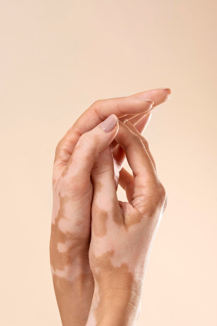 Vitiligo Research: Advancements And Future Directions