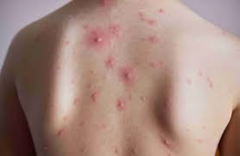 Unveiling Chickenpox: A Guide to Understanding, Managing, and Preventing the Varicella-Zoster Virus.