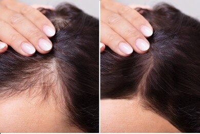 The Best Hair Loss Treatments for Women A Comprehensive Guide