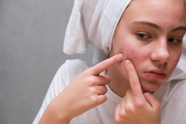 Step-by-Step Guide to Treating Acne Scars.