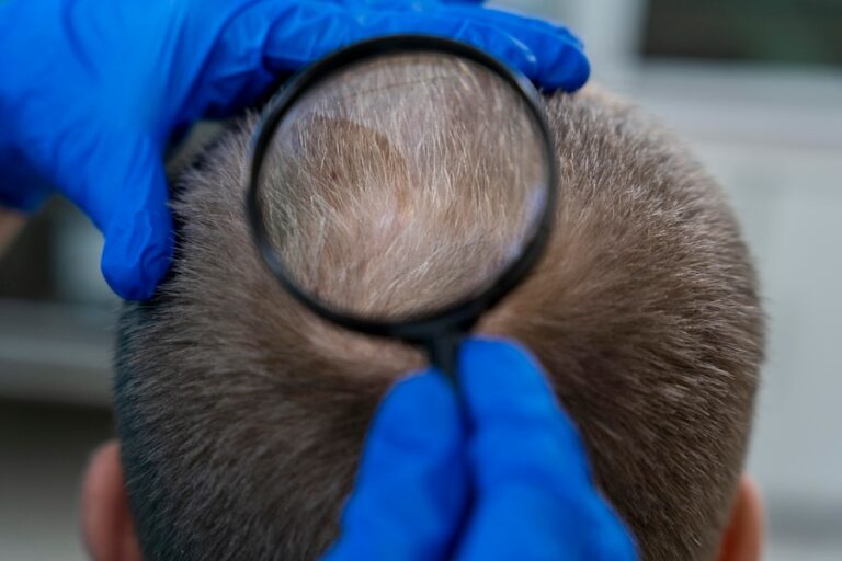 Step-by-Step Guide to Alopecia Treatment.