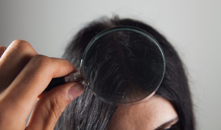 Expert Tips for Choosing the Best Dandruff Treatment.